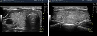 Допплерография ― допплеровское ультразвуковое исследование интенсивности  кровотока узлов щитовидной железы. Клиника Щитовидной Железы доктора А. В.  Ушакова ― официальный сайт.