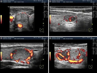 Услуга УЗИ щитовидной железы в медцентре Гарантия