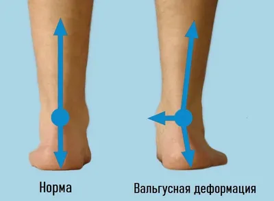 Вальгусная деформация стопы и шейки бедра у детей и взрослых, лечение в  Москве