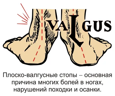 Владимир Животов - Неизлечимое заболевание или всего лишь симптом? ⠀  Уважаемые подписчики, вальгус – одна из ваших «любимых» тем, и вы часто  спрашиваете: можно ли вылечить вальгус у ребенка трех, пяти, семи