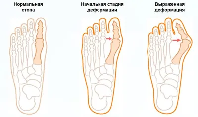 Внимательно посмотрите на стопы ребёнка. ⠀ Вальгус - это установка стопы,  при которой она заваливается внутрь. ⠀ Каждой маме важно понимать… |  Instagram