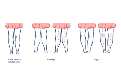 Варусная деформация стоп у детей. Варус причины, симптомы, лечение  остеопатией. - YouTube
