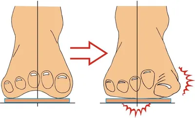 Халюс-Вальгус - косточки на ногах: причины и лечение | Медицинский дом Odrex