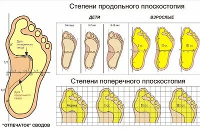 Вальгусная деформация стопы (вальгус) у детей — причины, симптомы, лечение