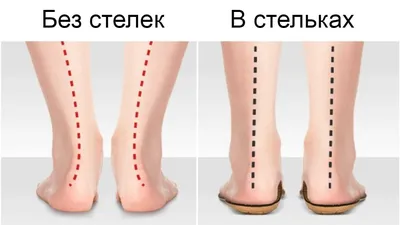 Как могут помочь тейпы при вальгусной деформации стопы у ребёнка