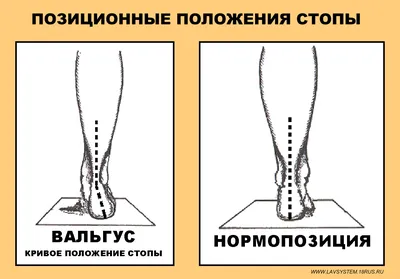 ОСАНКА ВАЛЬГУС ПЛОСКОСТОПИЕ on Instagram: \"90% мам не знают, что вальгус у  ребенка можно исправить самостоятельно, занимаясь дома физиологичными  упражнениями по 15 минут каждый день. ⠀ 50% из них бегут за стельками