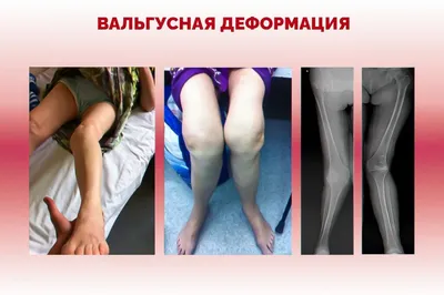 Вальгусная деформация коленных суставов у детей фото фото