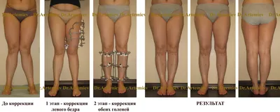 Варусная деформация стопы, голени | Варус стопы у детей и взрослых ᐉ  Ladisten