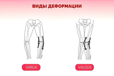 Выпрямление ног - исправление Х-образной кривизны (вальгусной деформации) в  Москве