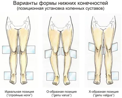 Вальгус (Valgus) | Ортофит