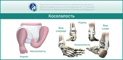 Деформации коленных суставов: разбираемся с экспертом ННИИТО | «ННИИТО им.  Я.Л.Цивьяна» Минздрава России