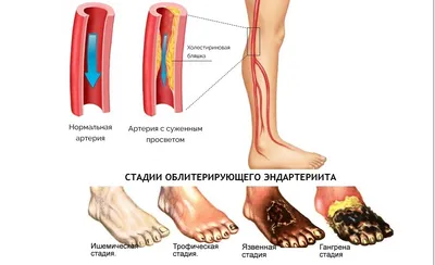 Вальгусная деформация стопы: причины, симптомы и лечение всех видов  заболеваний в ФНКЦ ФМБА в Москве