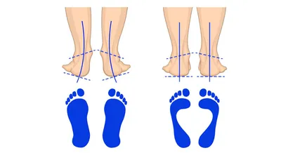 Особенности ортопедических стелек для детей при лечении вальгусной  деформации стоп