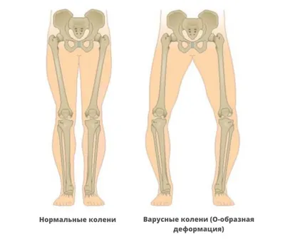 Варусная деформация — Википедия