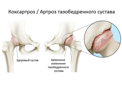 Вальгусная деформация стопы: — Dalossa