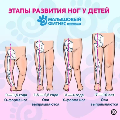 Вальгусная деформация стопы у ребенка фото фото