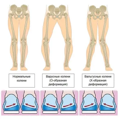 ortosalon.tj - Поможем подобрать вашим деткам ортопедические стельки при  вальгусной и варусных стопах. Что такое вальгусная и варусная стопа?  Вальгусная и варусная стопа у детей. Вальгусная деформация стоп –  ортопедическое отклонение, при