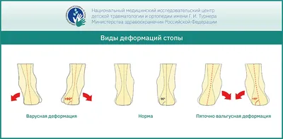 Как определить плоскостопие у ребенка? Лечение разных видов деформации стопы  у детей в НМИЦ им. Г. И. Турнера