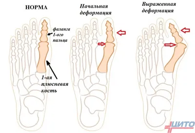 Вальгусная деформация у взрослых и детей | «Аюрведа Бел»