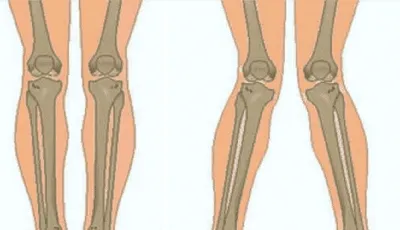 Вальгусная деформация стопы (Hallux valgus): лечение в Москве в Клинике  подологии Полёт