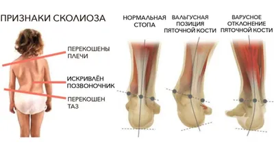 Вальгусная деформация стопы (вальгус) у детей — причины, симптомы, лечение
