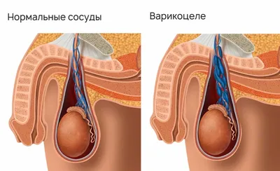 Что делать при варикоцеле? Нужно ли оперировать? ⋮ Медицинский центр  MEDICAL PLAZA