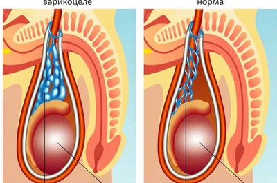 Варикоцеле | ТС Клиника — г. Краснодар