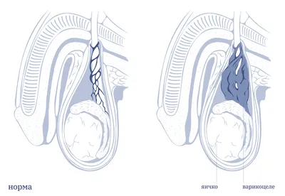 Варикоцеле. Нужна ли операция и будет ли бесплодие? | Купрум