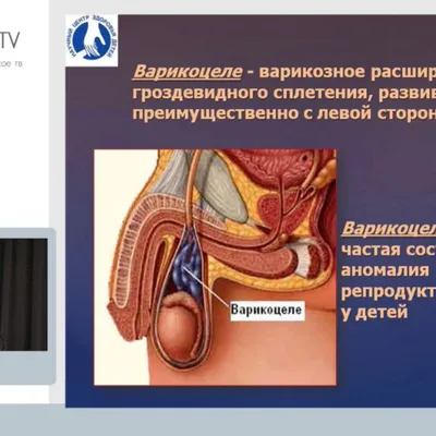 Shifokor LDA - ВАРИКОЦЕЛЕ. МУЖСКАЯ БОЛЕЗНЬ С ЖЕНСКИМ ХАРАКТЕРОМ Брак с  браком Согласно расхожему мнению, каждый мужчина должен в своей жизни  сделать три вещи: построить дом, посадить дерево и вырастить ребенка. Те,