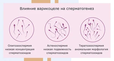 Сравнительный анализ оперативных методов вмешательства при варикоцеле у  подростков Воронежской области - Бакаева - Молодежный инновационный вестник