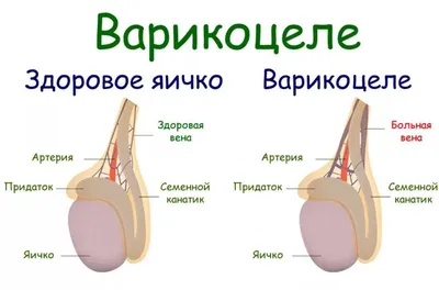 Варикоцеле: болезнь, которая делает мужчину бесплодным | Счастливые  родители: Parents.ru | Дзен