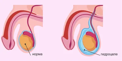 Диссертация на тему \"Ретроградная эндоваскулярная окклюзия при варикоцеле у  детей и подростков\", скачать бесплатно автореферат по специальности  14.00.09 - Педиатрия