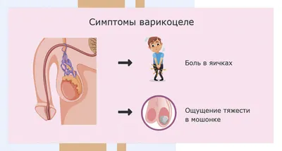 Варикоцеле: причины, симптомы и лечение в Клинике АльтраВита