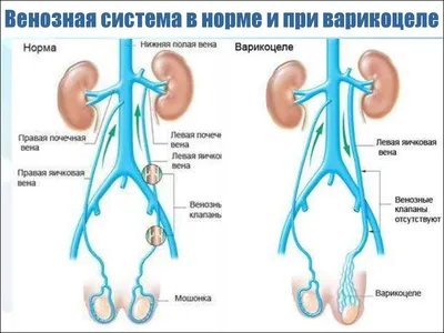 ➤ Водянка яичка – Блог уролога Сергея Люлько в Киеве