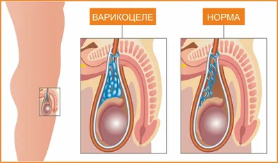 Варикоцеле - Хирургические операции в стационаре Новая Мировая Хирургия