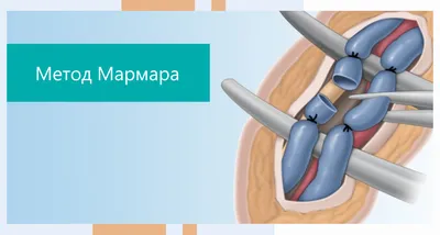 Операция Мармара при варикоцеле у подростков | UroWeb.ru — Урологический  информационный портал!