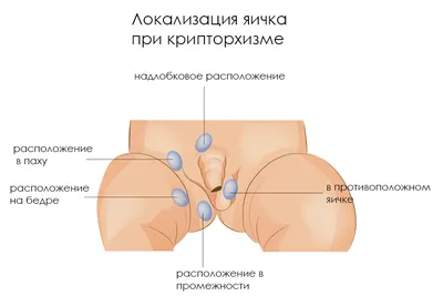 Варикоцеле у подростков: причины, симптомы, лечение