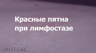 Может ли варикозное расширение вен появиться только во время беременности?  - статьи медицинского центра доктора Бегмы в Москве