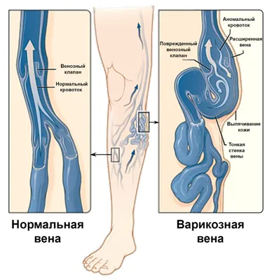 Лечение варикоза - противоварикозная программа в Киеве