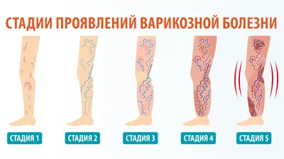 Флеболог Київ - С момента лазерного лечения варикоза прошло 2 месяца, до  момента процедуры - 15 лет варикозной болезни отёки, неоднократно -  тромбофлебит. Время, которое заняла эта манипуляция - 35 минут под