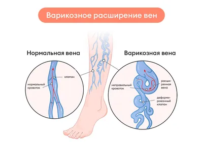 Тромбофлебит: симптомы, причины, классификация, осложнения, что делать,  профилактика