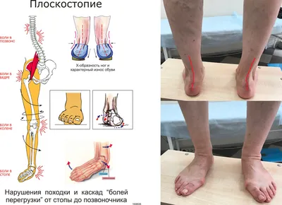 Варикозное расширение вен: причины, симптомы, диагностика, лечение