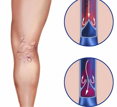 Варикоза нет - ⚡Флебэктомия — удаление больных вен через разрезы:  одновременно в паху, в области лодыжки и иногда под коленом. Врач  добирается до вены, вводит металлический зонд, привязывает один конец вены и