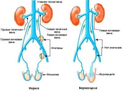 Варикоцеле: хирургическая коррекция - клиника Уросвит