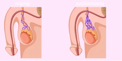 Шишка в паху у мужчин - Медицинский центр Семья | Липецк