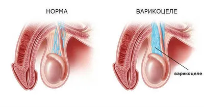 Варикоцеле (варикоз яичек) лечение в Украине | Клиника Биляка