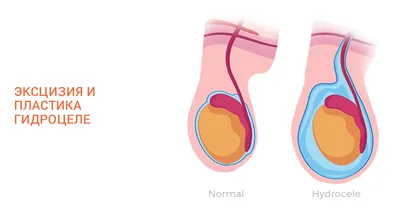 Варикоцеле у мужчин: лечение, степени, симптомы и причины