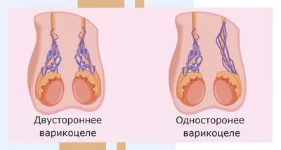 Варикоцеле - Медицинский центр «На Восточной»