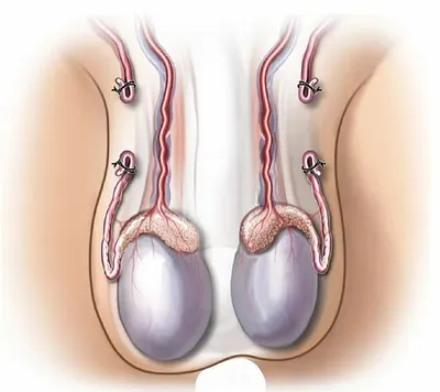 Как обнаружить и вылечить варикоцеле — блог медицинского центра ОН Клиник