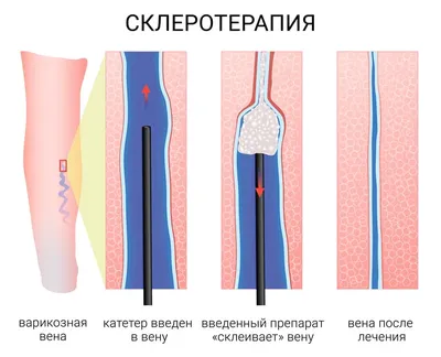 Варикоцеле | ТС Клиника — г. Краснодар